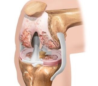 Der Knorpel befindet sich am Knie