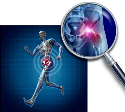 Hüftgelenk -Osteoarthritis