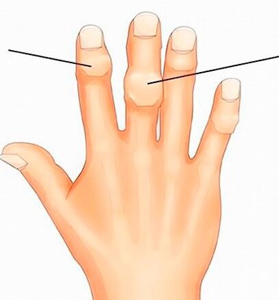 Heberden- und Bouchard-Knötchen in den Interphalangealgelenken bei Arthrose