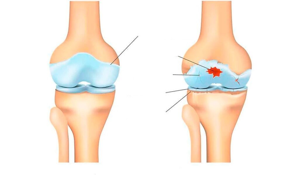 gesundes und Arthrose-Gelenk