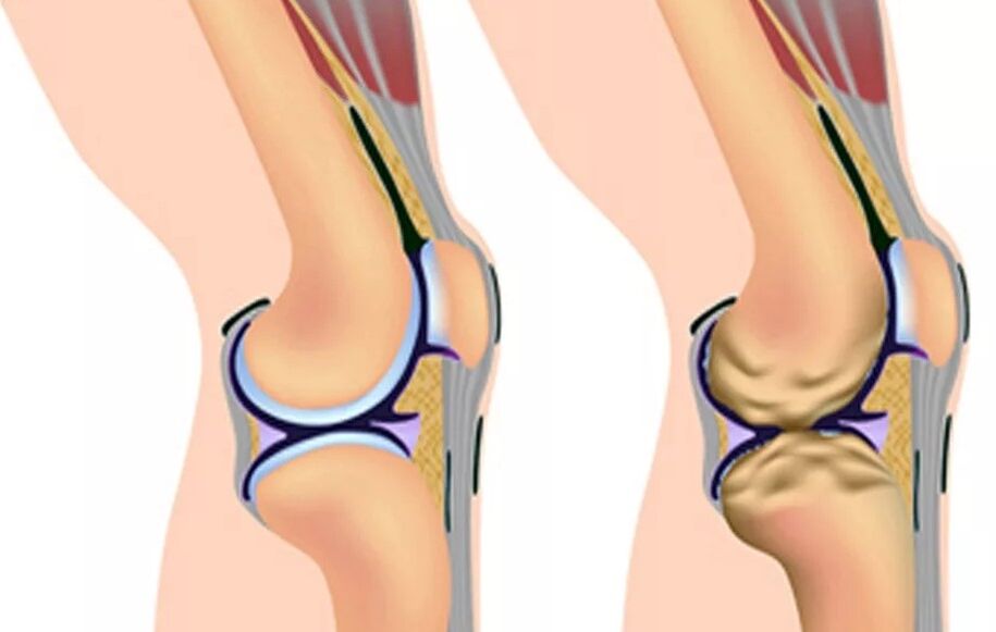 Der erste Grad der Knie -Arthrose