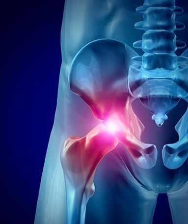 Hüftschmerzen Foto 1