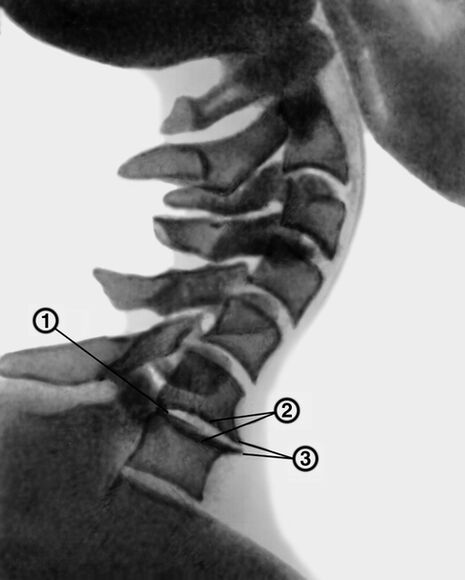 Röntgenaufnahme der Halswirbelsäule mit Osteochondrose.