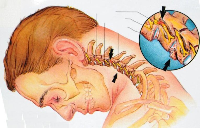Symptome einer zervikalen Osteochondrose
