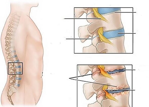 Veränderungen der Bandscheiben aufgrund von Osteochondrose.