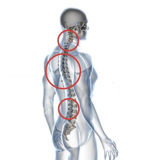 Wie äußert sich Osteochondrose